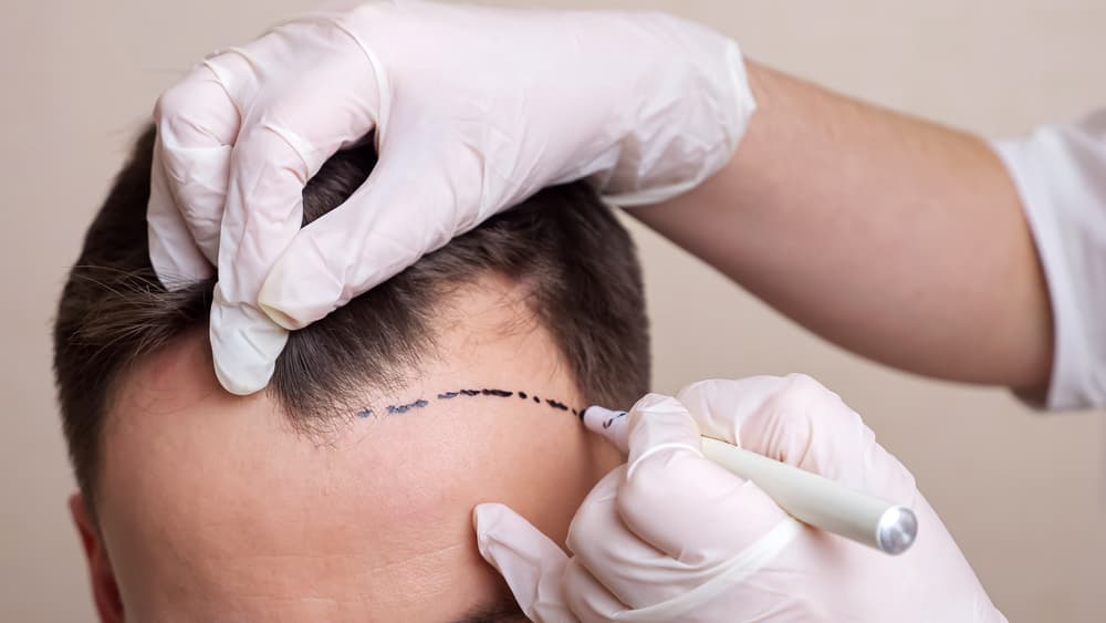 A Beginner's Guide to Hair Transplantation