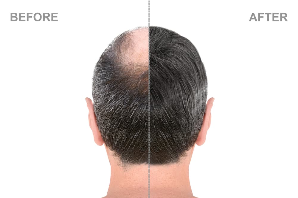 How Hair Loss Differs Between Men and Women