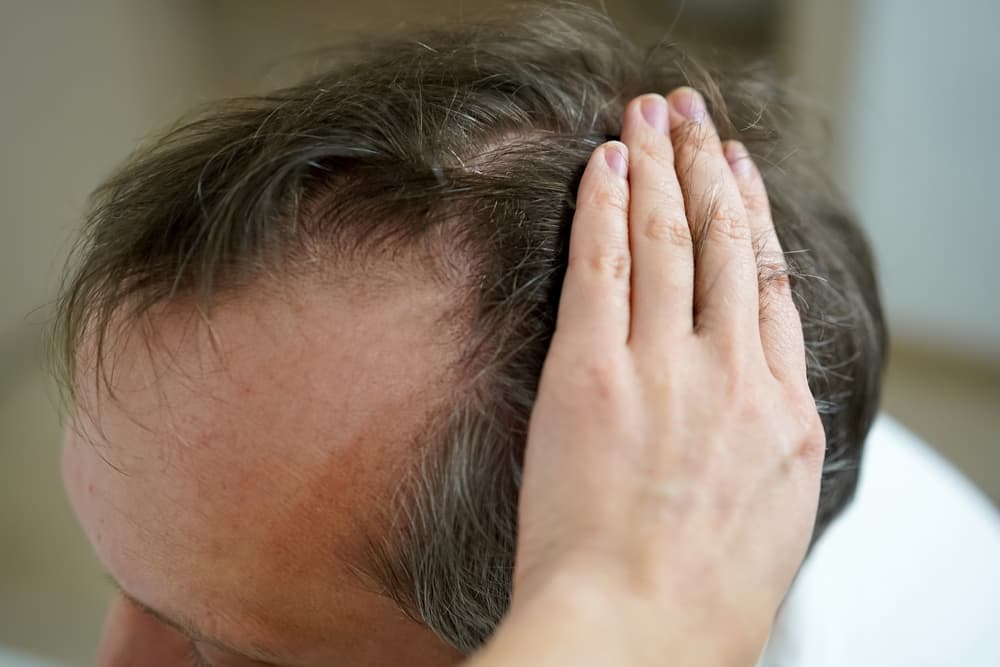 Understanding the Connection Between Hair Loss and Autoimmune Diseases