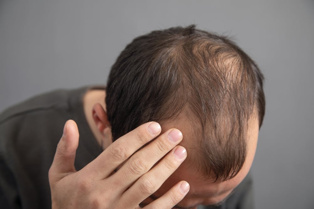 How to Choose the Right Hair Loss Specialist Internationally