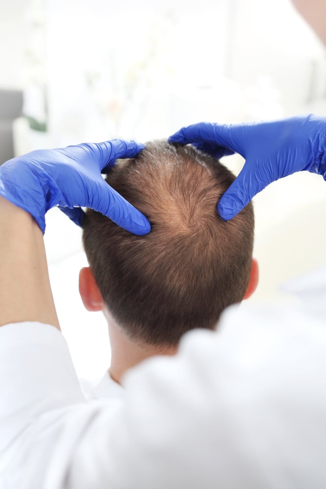 How to Manage Hair Loss During Chemotherapy