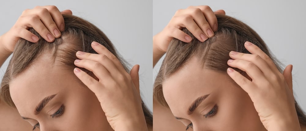 Understanding Hair Loss in Postpartum Women