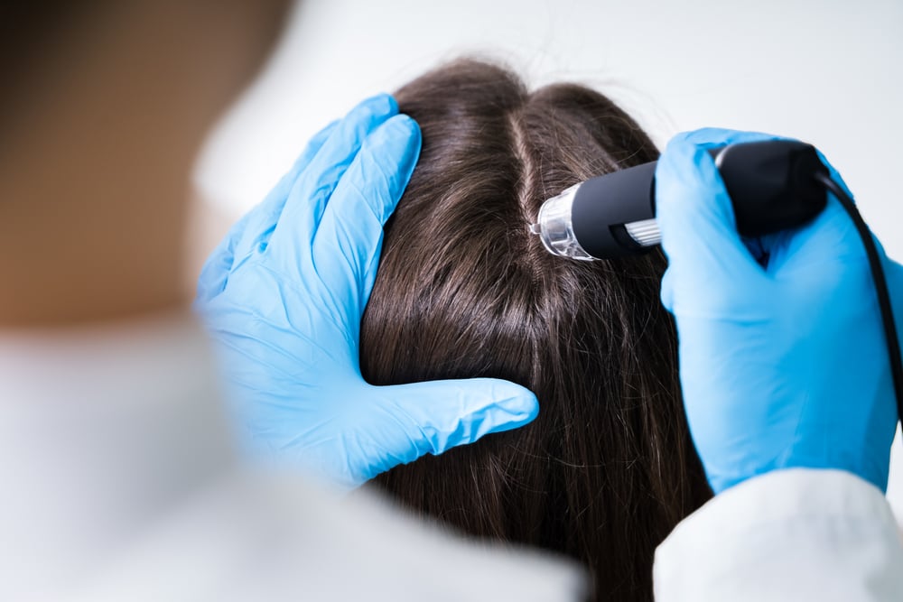 How to Identify the Early Signs of Hair Loss