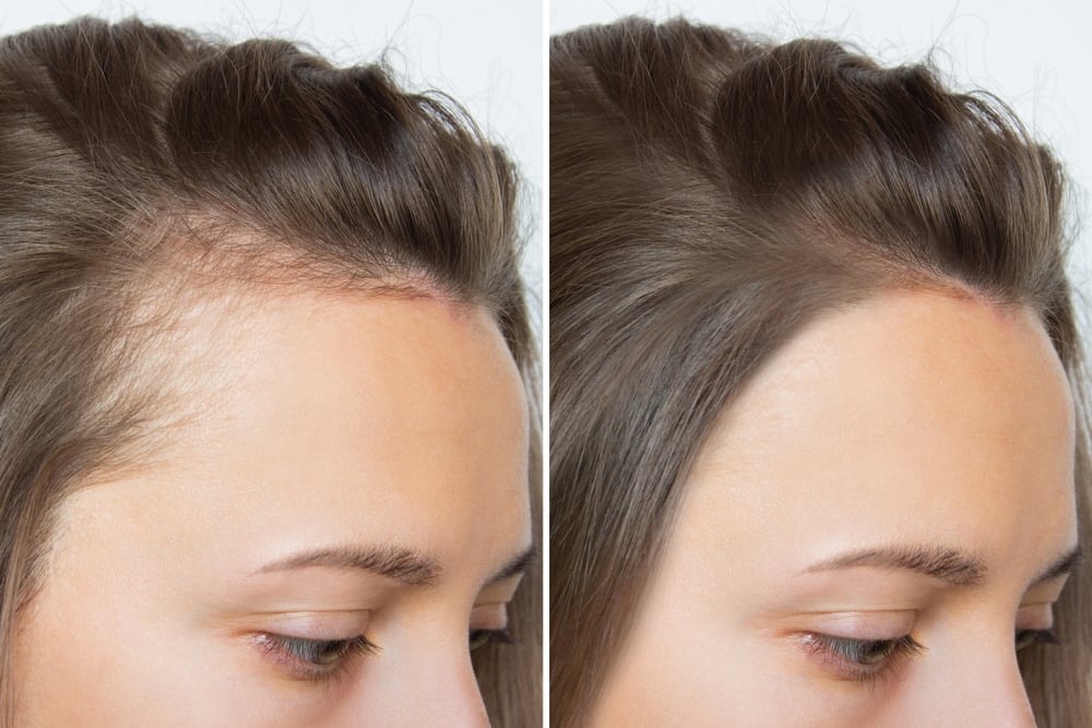 Hair Loss in Women: Common Causes and Solutions