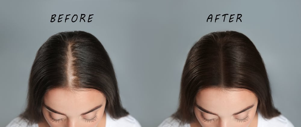 The Science Behind Hair Loss: What You Need to Know